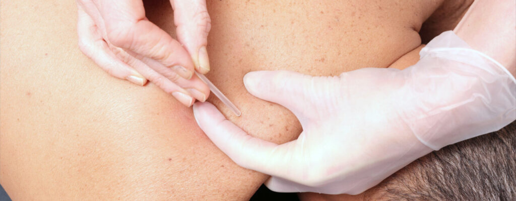 Dry Needling El Paso, Texas